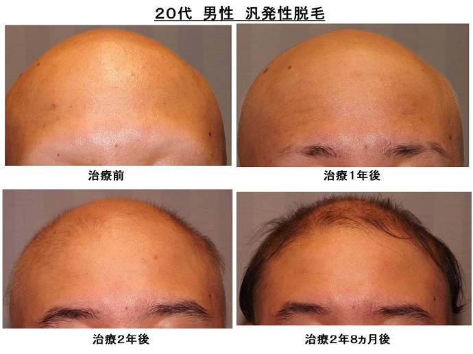円形脱毛症　病院""